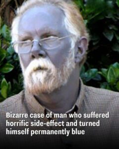 Bizarre case of man who suffered horrific side-effect and turned himself permanently blue